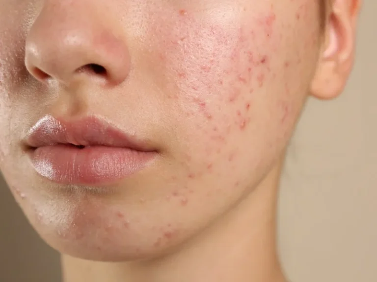 Acne