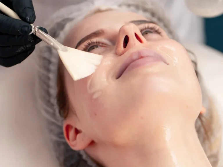 Chemical Peels