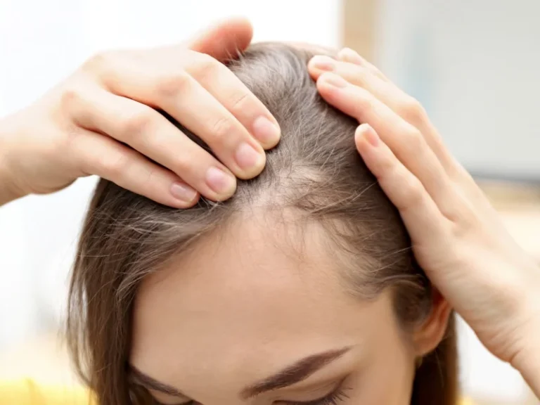 Hair Loss