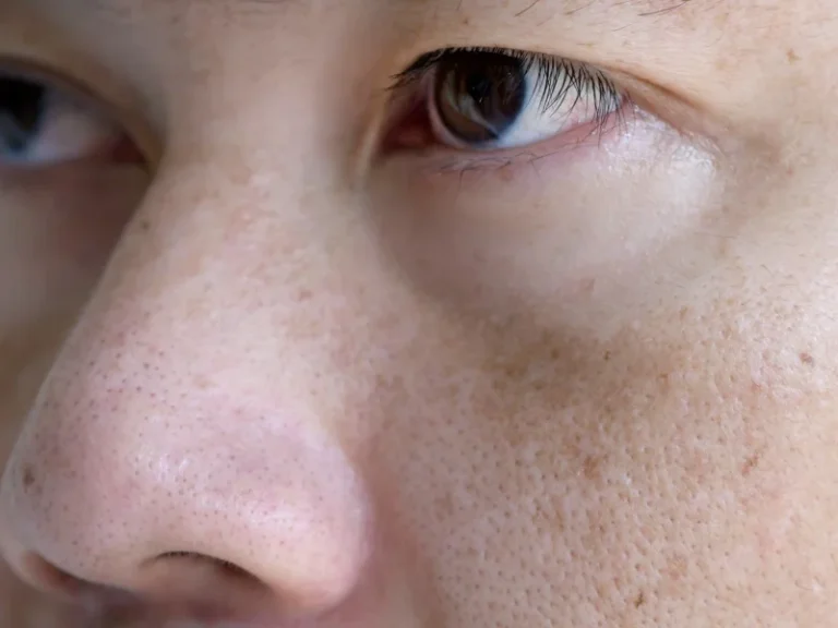 Melasma