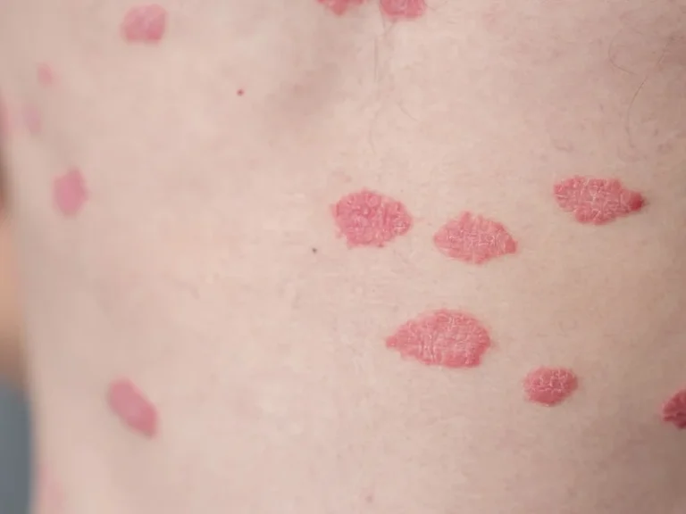 Psoriasis