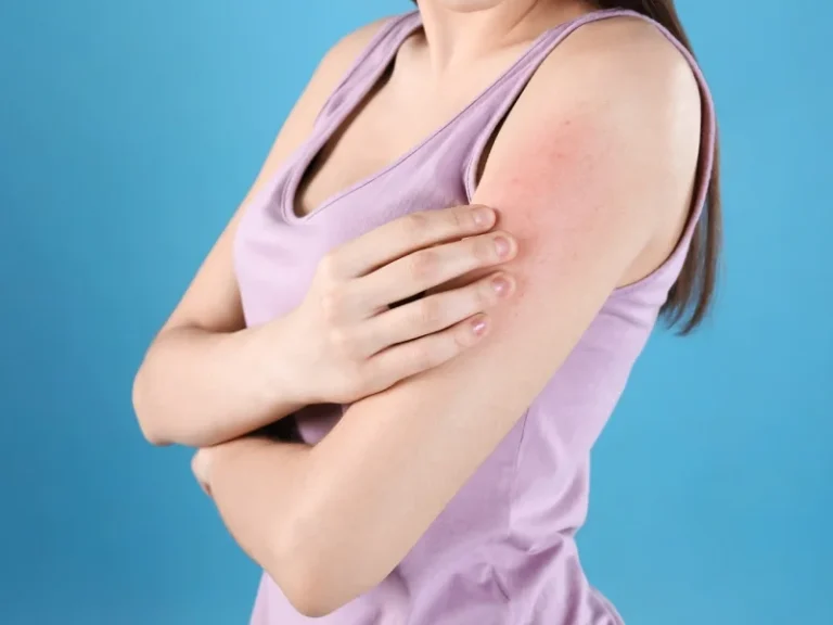 Rashes