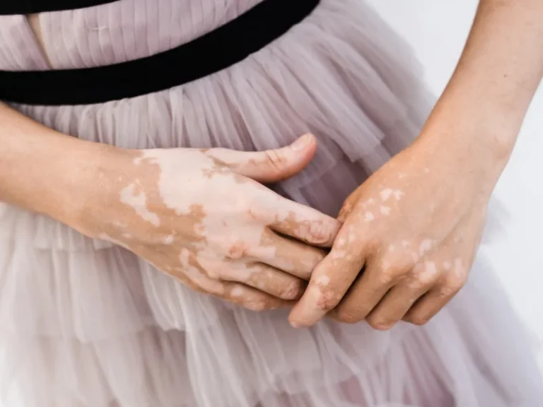 Vitiligo