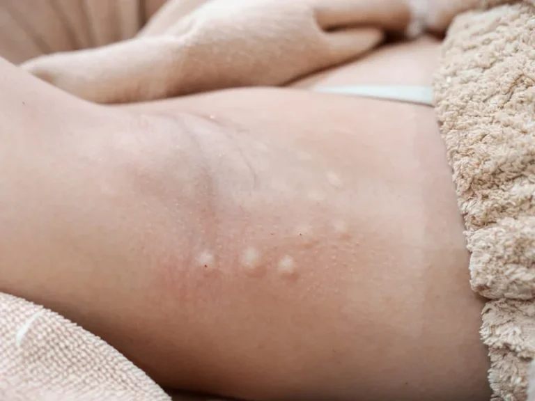 Hidradenitis Suppurativa