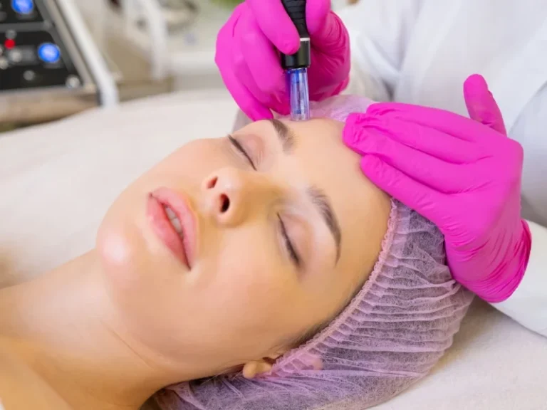 Microneedling