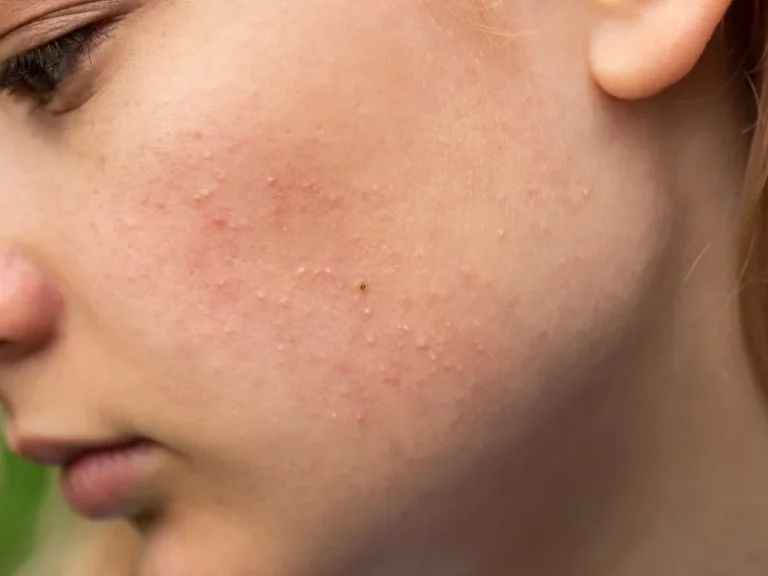 Rosacea